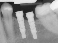dental Implant X-ray