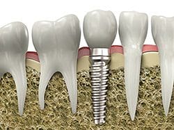 a tooth implant in between normal teeth